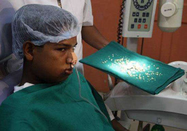 印度七岁男孩患怪病嘴里长出526颗牙平时怎么吃饭