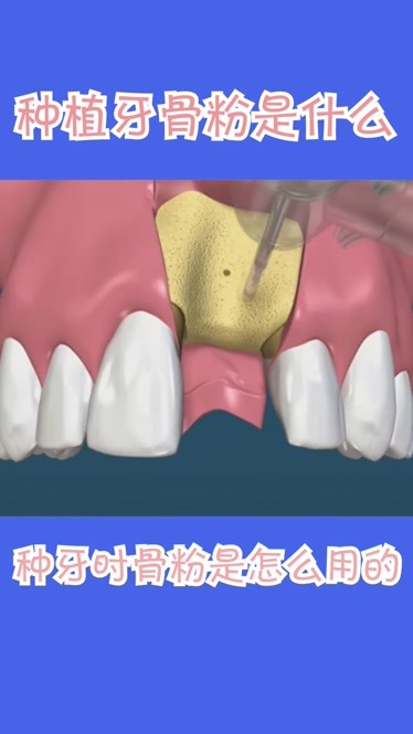 种植牙骨粉是什么 做种植牙骨粉是怎么用的-原创-完整版视频在线观看